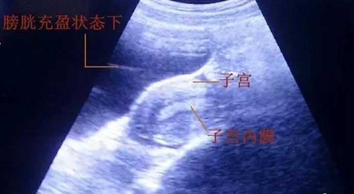 广州代孕医院哪家好|营口姐妹为啥试管婴儿胚胎移植前要憋尿呢？