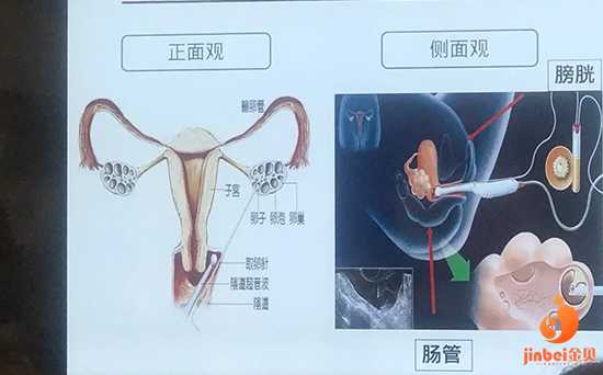 广州代孕双胞胎成功率在多少|华西试管日记之试管婴儿取卵全部流程