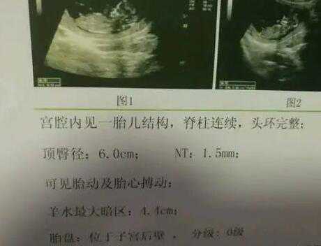 广州代怀生机构孕妈妈 广州医科大学第三附属医院 ‘无创DNA说两个三体大于